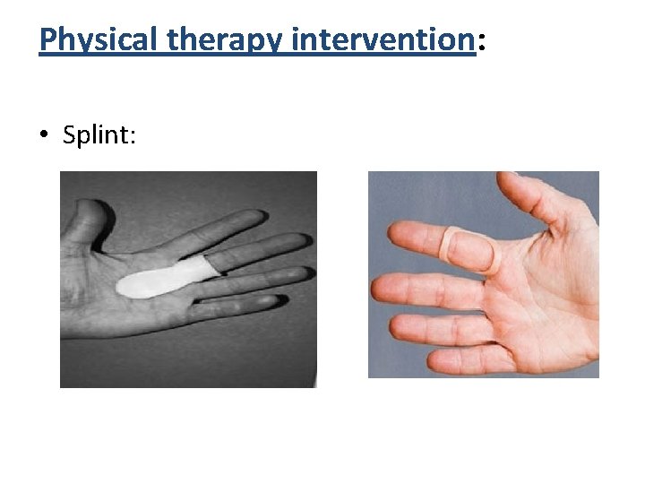 Physical therapy intervention: • Splint: 