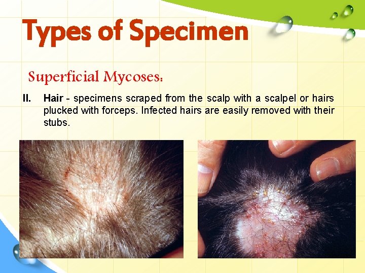 Types of Specimen Superficial Mycoses: II. Hair - specimens scraped from the scalp with