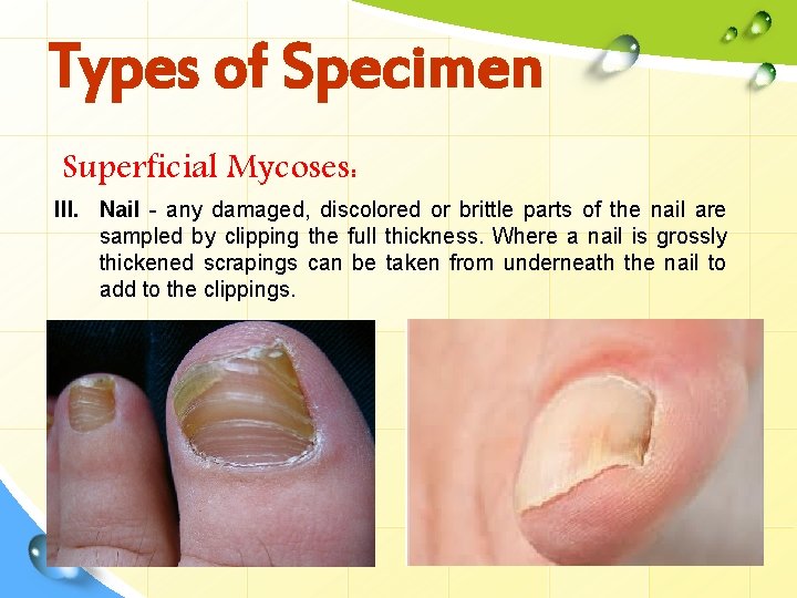 Types of Specimen Superficial Mycoses: III. Nail - any damaged, discolored or brittle parts