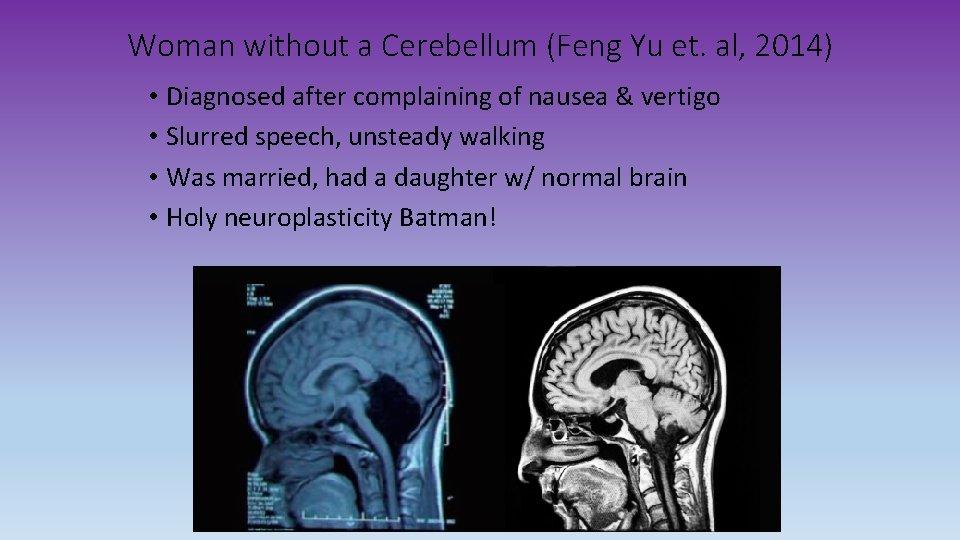 Woman without a Cerebellum (Feng Yu et. al, 2014) • Diagnosed after complaining of