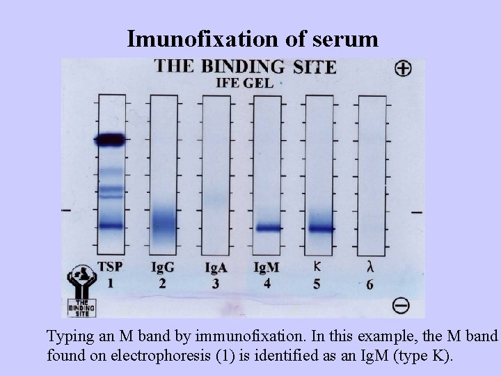 Imunofixation of serum Typing an M band by immunofixation. In this example, the M