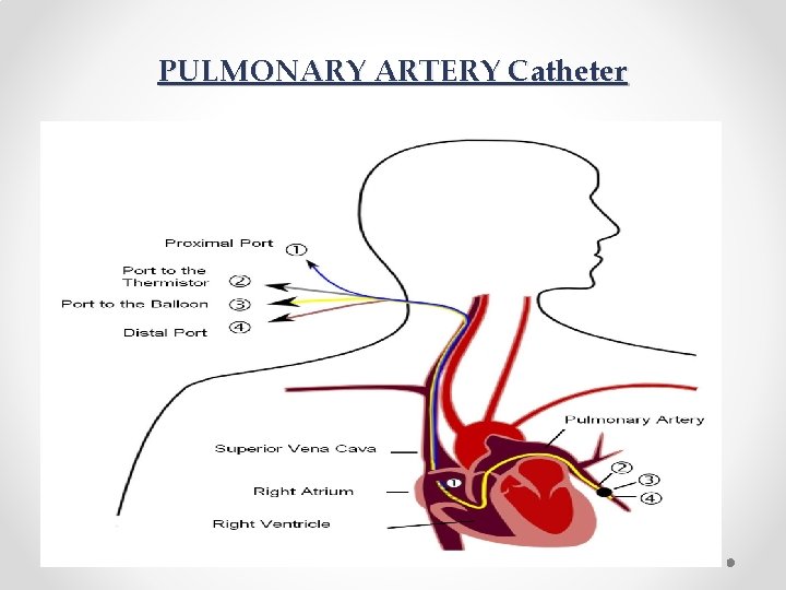PULMONARY ARTERY Catheter 
