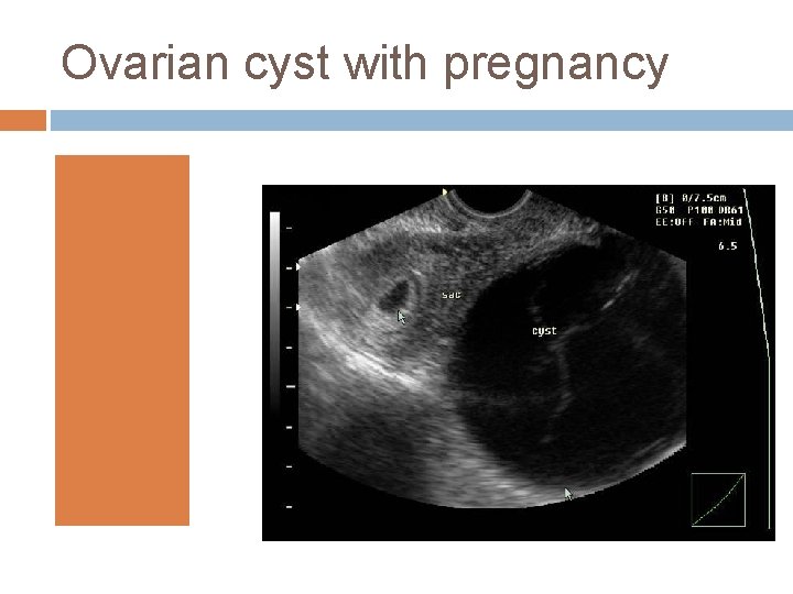 Ovarian cyst with pregnancy 