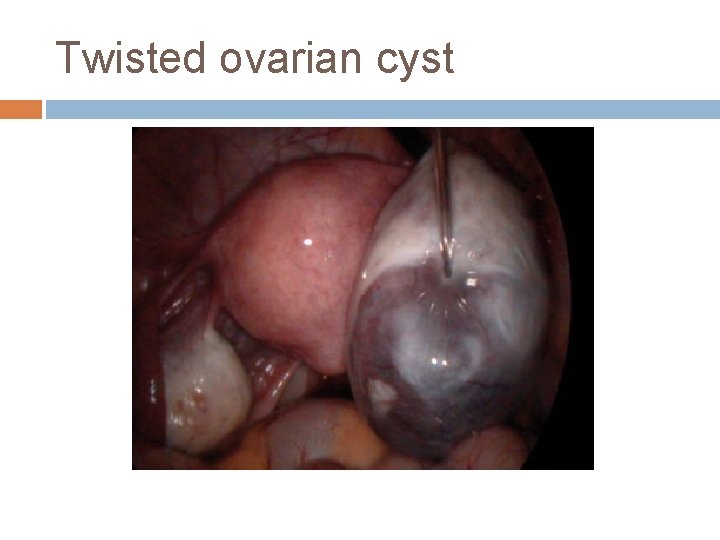 Twisted ovarian cyst 