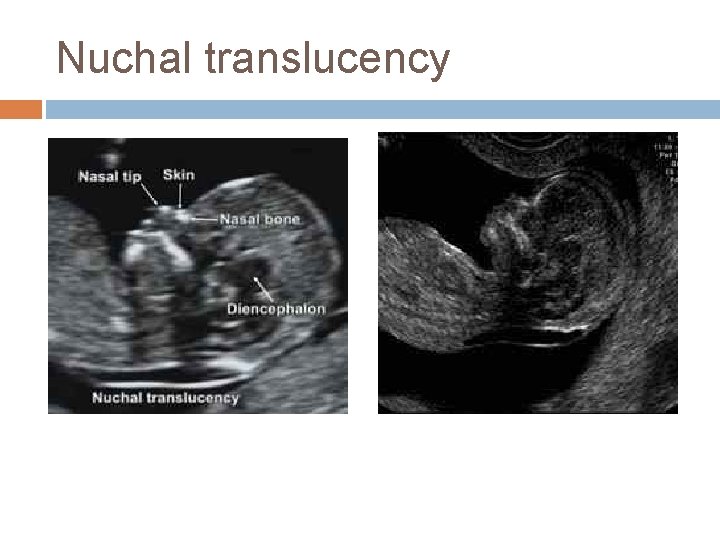 Nuchal translucency 