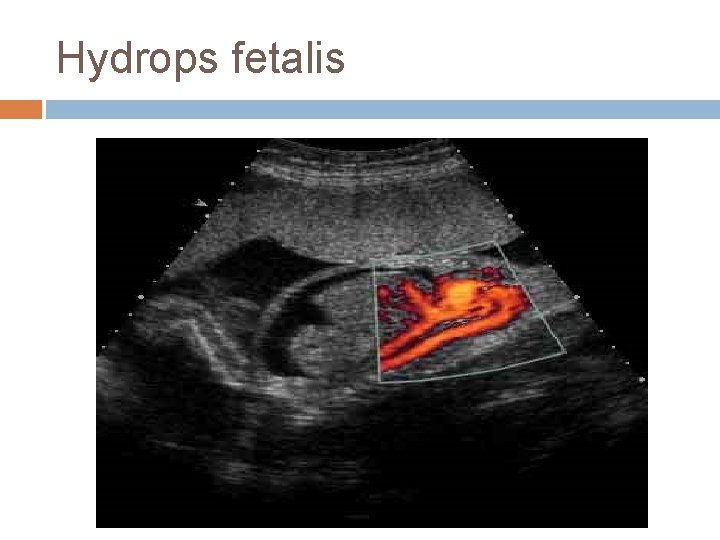 Hydrops fetalis 