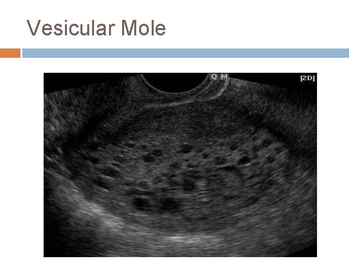 Vesicular Mole 