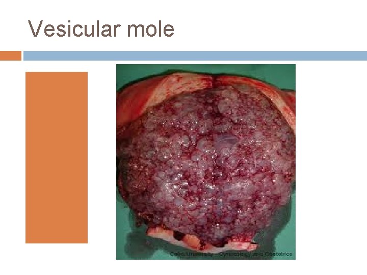 Vesicular mole 