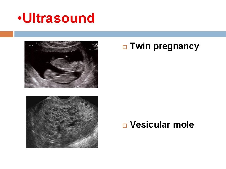  • Ultrasound Twin pregnancy Vesicular mole 