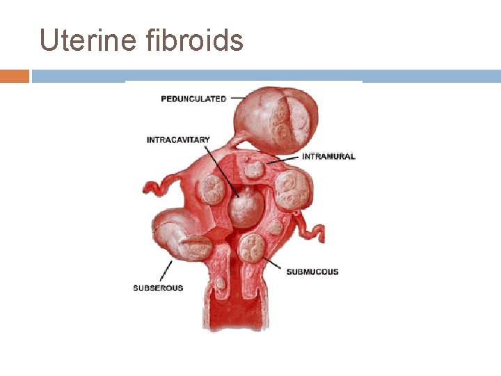 Uterine fibroids 