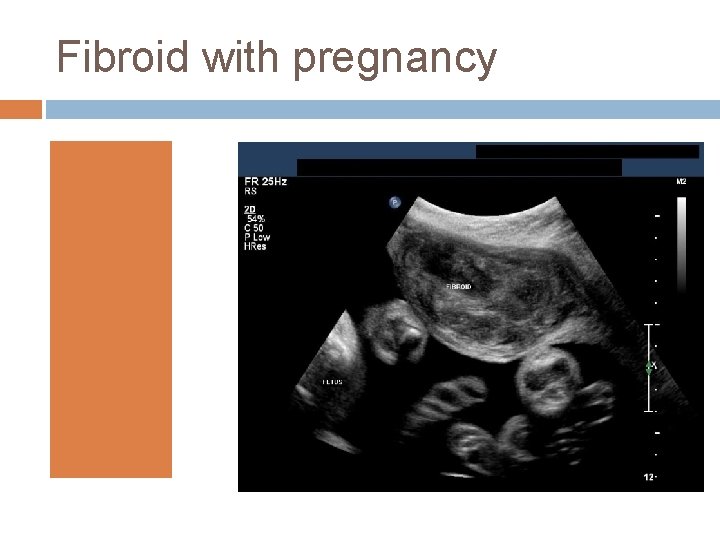 Fibroid with pregnancy 
