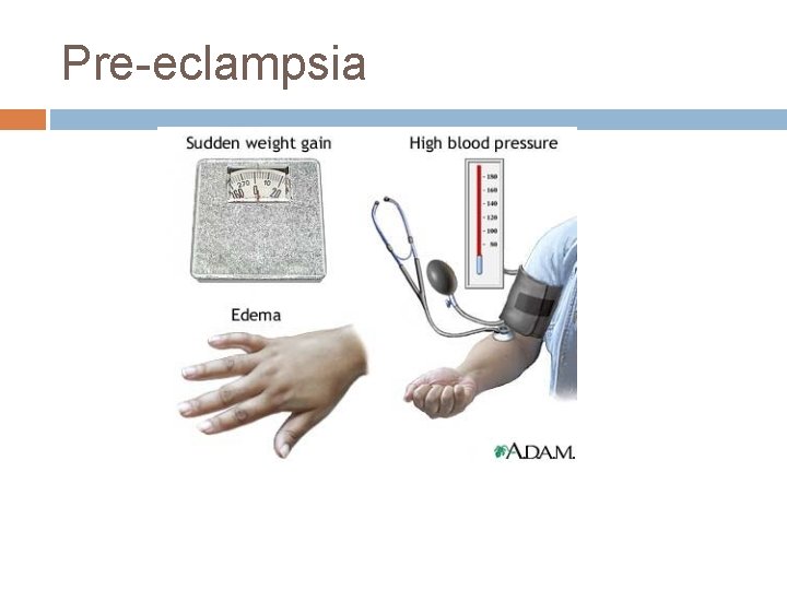 Pre-eclampsia 