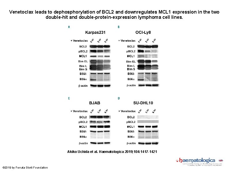 Venetoclax leads to dephosphorylation of BCL 2 and downregulates MCL 1 expression in the