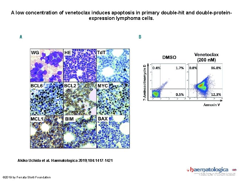 A low concentration of venetoclax induces apoptosis in primary double-hit and double-proteinexpression lymphoma cells.