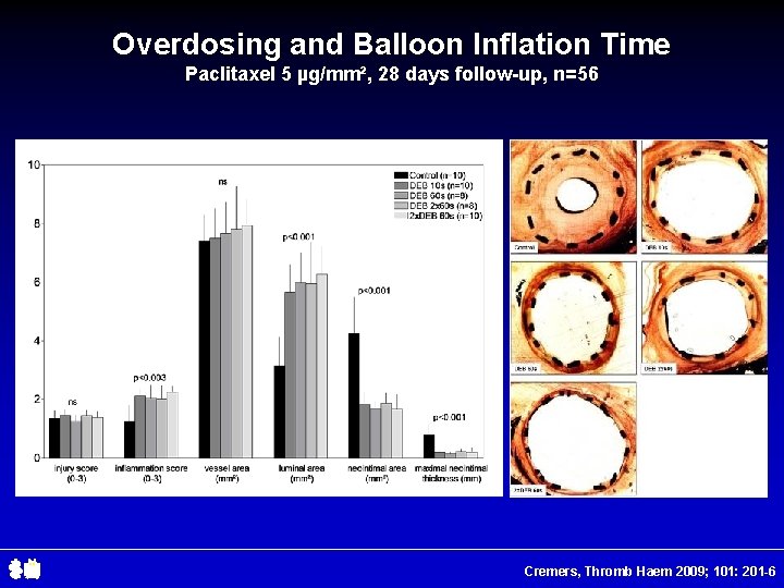 Overdosing and Balloon Inflation Time Paclitaxel 5 µg/mm², 28 days follow-up, n=56 Cremers, Thromb
