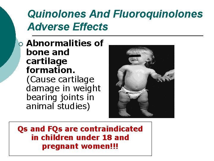 Quinolones And Fluoroquinolones Adverse Effects ¡ Abnormalities of bone and cartilage formation. (Cause cartilage