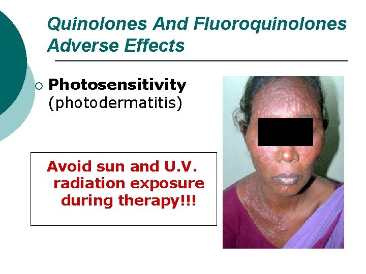 Quinolones And Fluoroquinolones Adverse Effects ¡ Photosensitivity (photodermatitis) Avoid sun and U. V. radiation