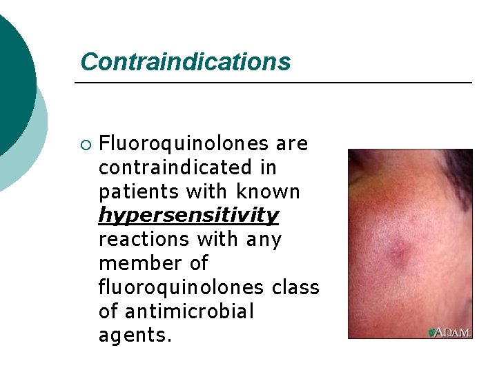 Contraindications ¡ Fluoroquinolones are contraindicated in patients with known hypersensitivity reactions with any member