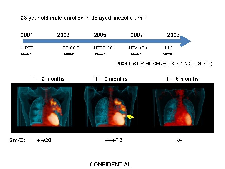 23 year old male enrolled in delayed linezolid arm: 2001 2003 HRZE PPt. OCZ