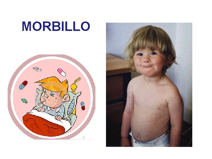 MORBILLO 