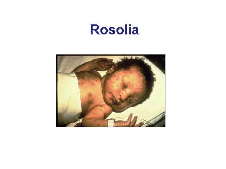 Rosolia 