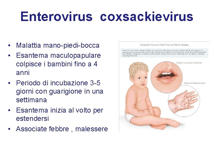 Enterovirus coxsackievirus • Malattia mano-piedi-bocca • Esantema maculopapulare colpisce i bambini fino a 4