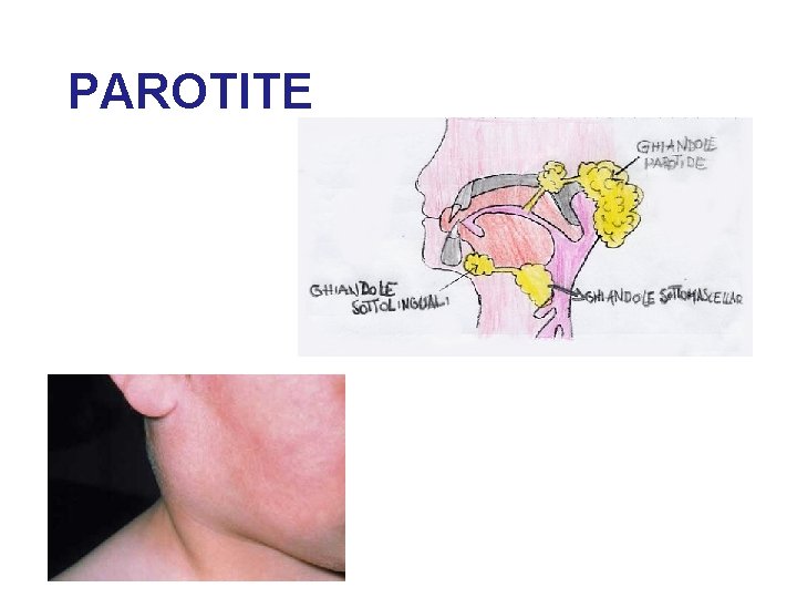 PAROTITE 