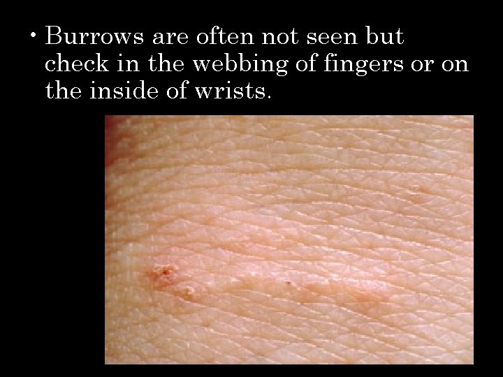  • Burrows are often not seen but check in the webbing of fingers