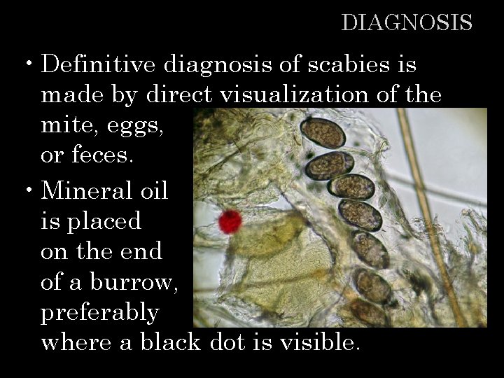 DIAGNOSIS • Definitive diagnosis of scabies is made by direct visualization of the mite,