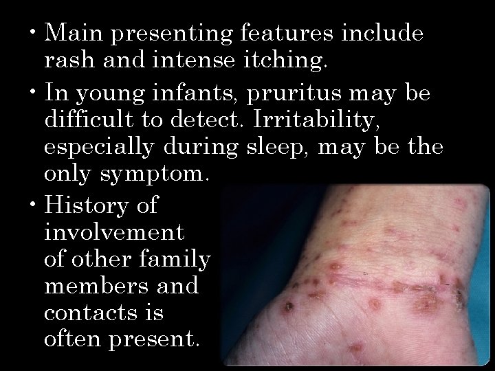  • Main presenting features include rash and intense itching. • In young infants,