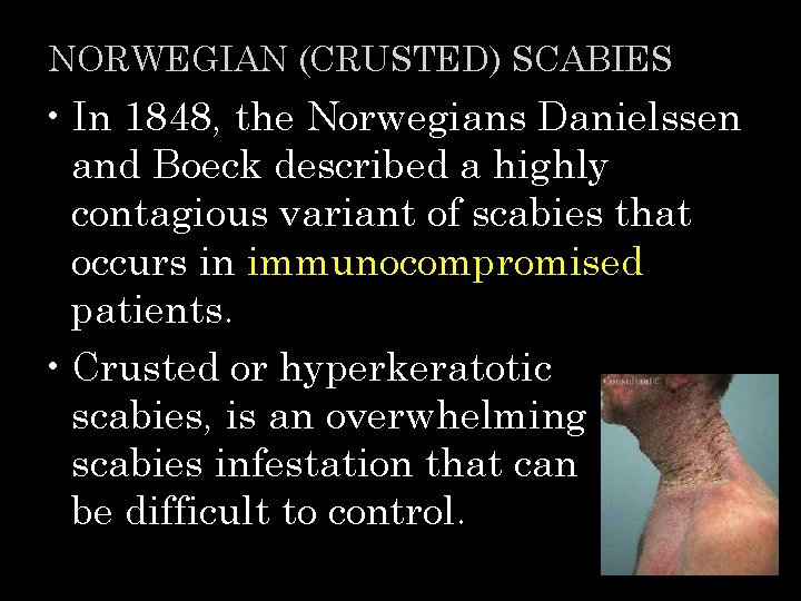 NORWEGIAN (CRUSTED) SCABIES • In 1848, the Norwegians Danielssen and Boeck described a highly