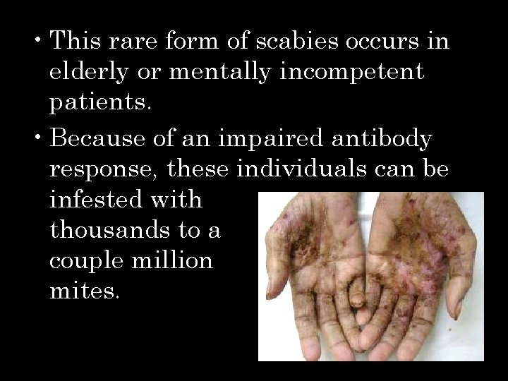  • This rare form of scabies occurs in elderly or mentally incompetent patients.