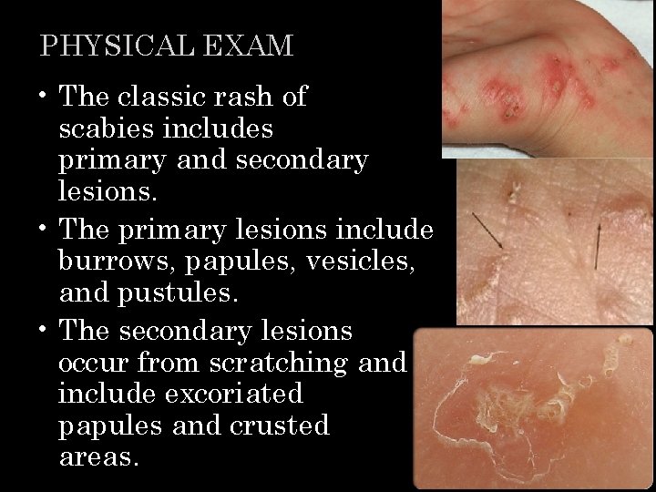 PHYSICAL EXAM • The classic rash of scabies includes primary and secondary lesions. •