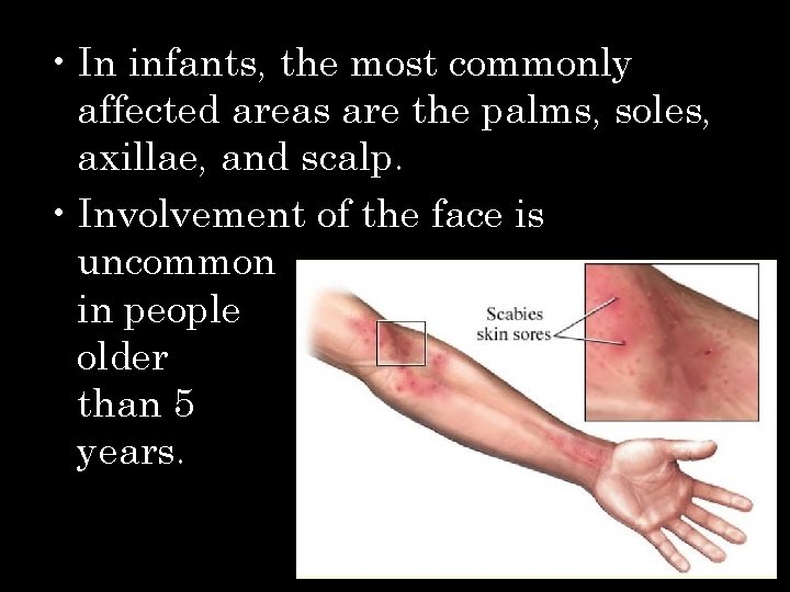 • In infants, the most commonly affected areas are the palms, soles, axillae,