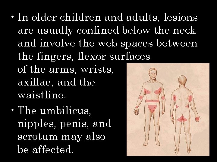  • In older children and adults, lesions are usually confined below the neck
