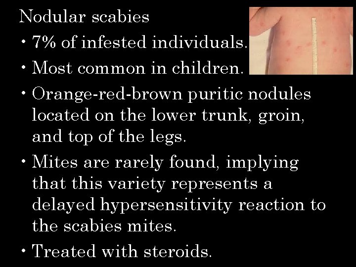 Nodular scabies • 7% of infested individuals. • Most common in children. • Orange-red-brown