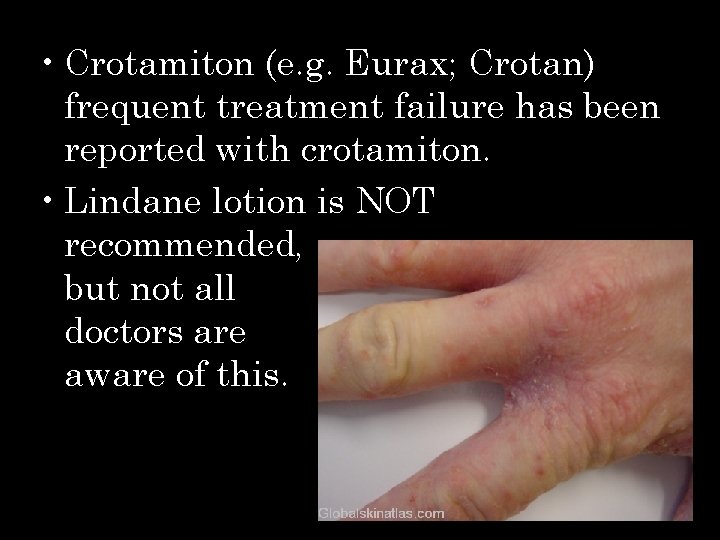  • Crotamiton (e. g. Eurax; Crotan) frequent treatment failure has been reported with