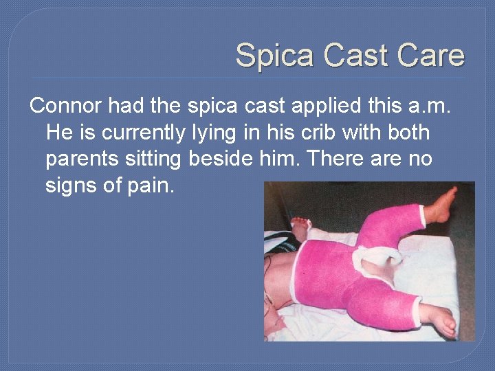 Spica Cast Care Connor had the spica cast applied this a. m. He is