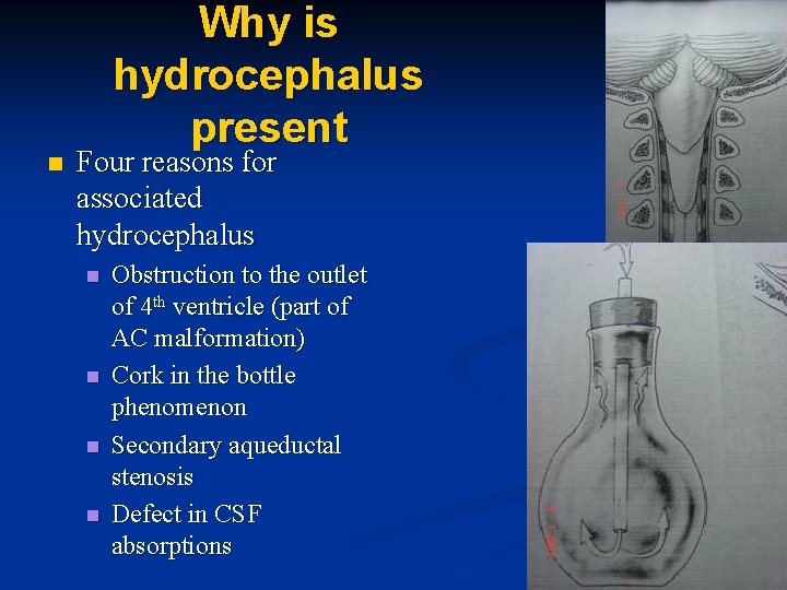 n Why is hydrocephalus present Four reasons for associated hydrocephalus n n Obstruction to