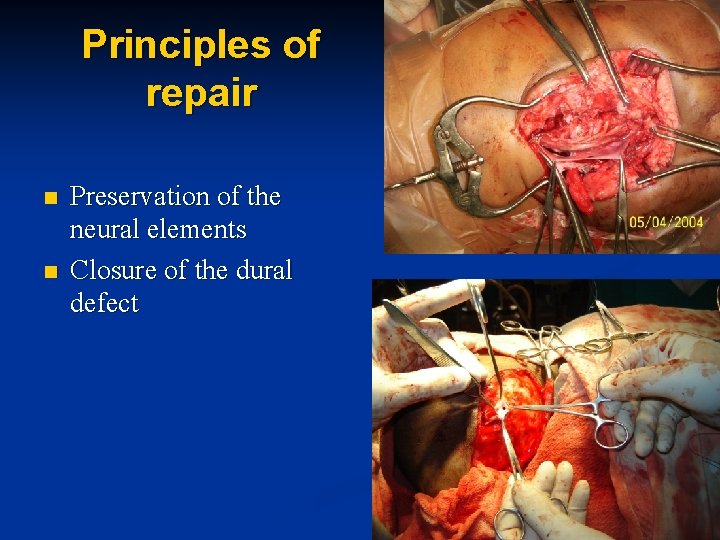 Principles of repair n n Preservation of the neural elements Closure of the dural