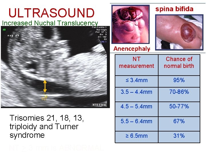 ULTRASOUND Increased Nuchal Translucency NT measurement Chance of normal birth ≤ 3. 4 mm