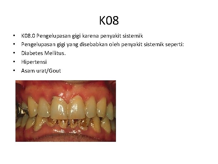 K 08 • • • K 08. 0 Pengelupasan gigi karena penyakit sistemik Pengelupasan