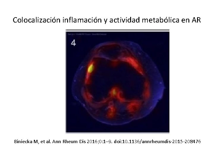 Colocalización inflamación y actividad metabólica en AR Biniecka M, et al. Ann Rheum Dis