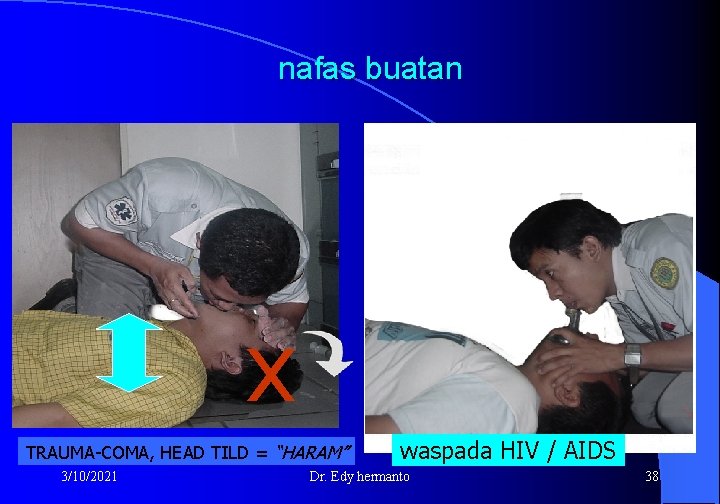 nafas buatan x TRAUMA-COMA, HEAD TILD = “HARAM” 3/10/2021 waspada HIV / AIDS Dr.