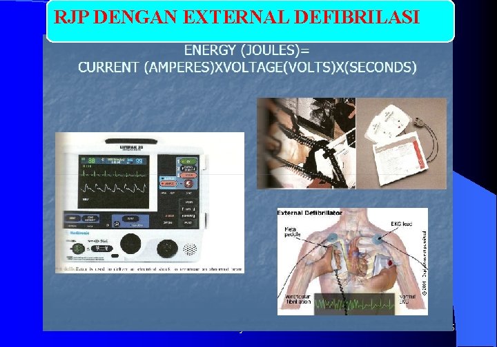 RJP DENGAN EXTERNAL DEFIBRILASI 3/10/2021 Dr. Edy hermanto 65 