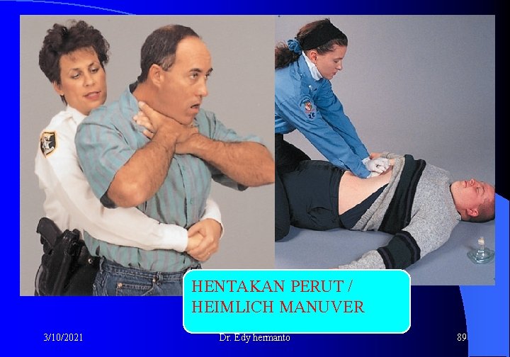 HENTAKAN PERUT / HEIMLICH MANUVER 3/10/2021 Dr. Edy hermanto 89 