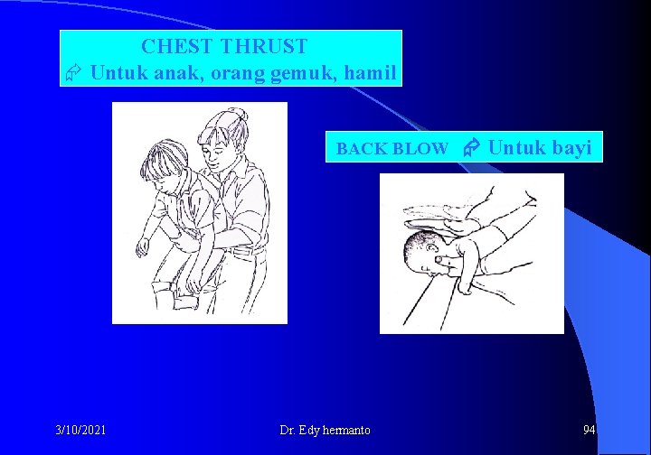 CHEST THRUST Untuk anak, orang gemuk, hamil BACK BLOW 3/10/2021 Dr. Edy hermanto Untuk
