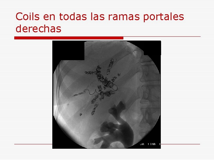 Coils en todas las ramas portales derechas 