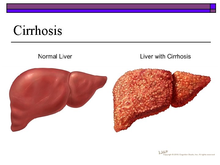 Cirrhosis 