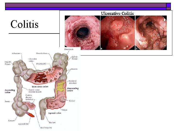 Colitis 